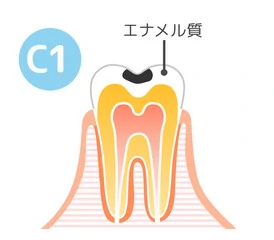 C1：エナメル質の虫歯