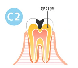 C2：象牙質の虫歯