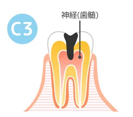 C3：神経まで達した虫歯