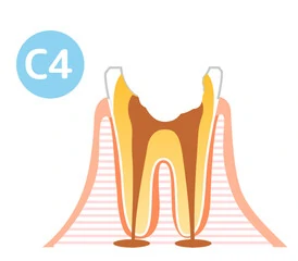 C4：歯の根だけが残った状態