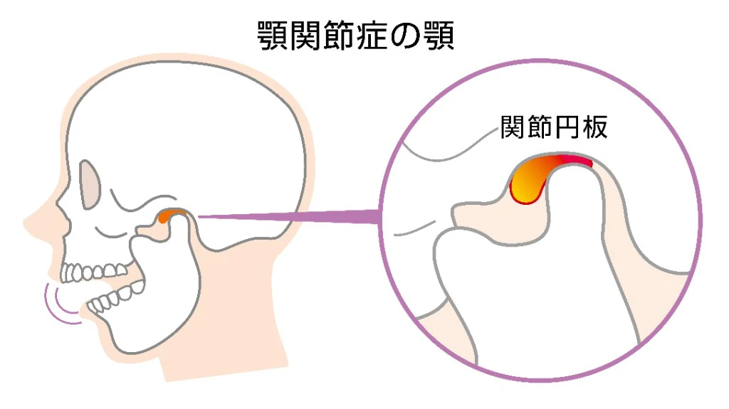 顎関節症とはどのような病気か